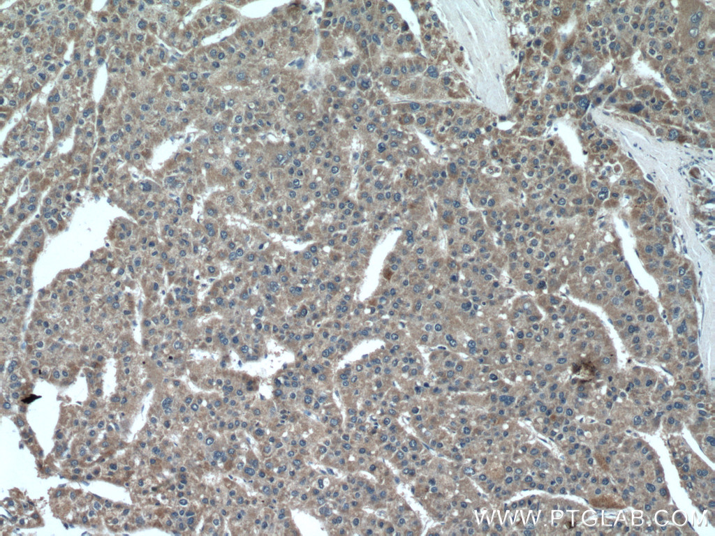 IHC staining of human liver cancer using 17356-1-AP