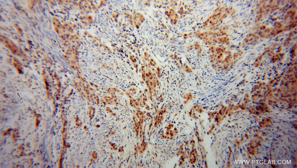 IHC staining of human endometrial cancer using 12169-1-AP