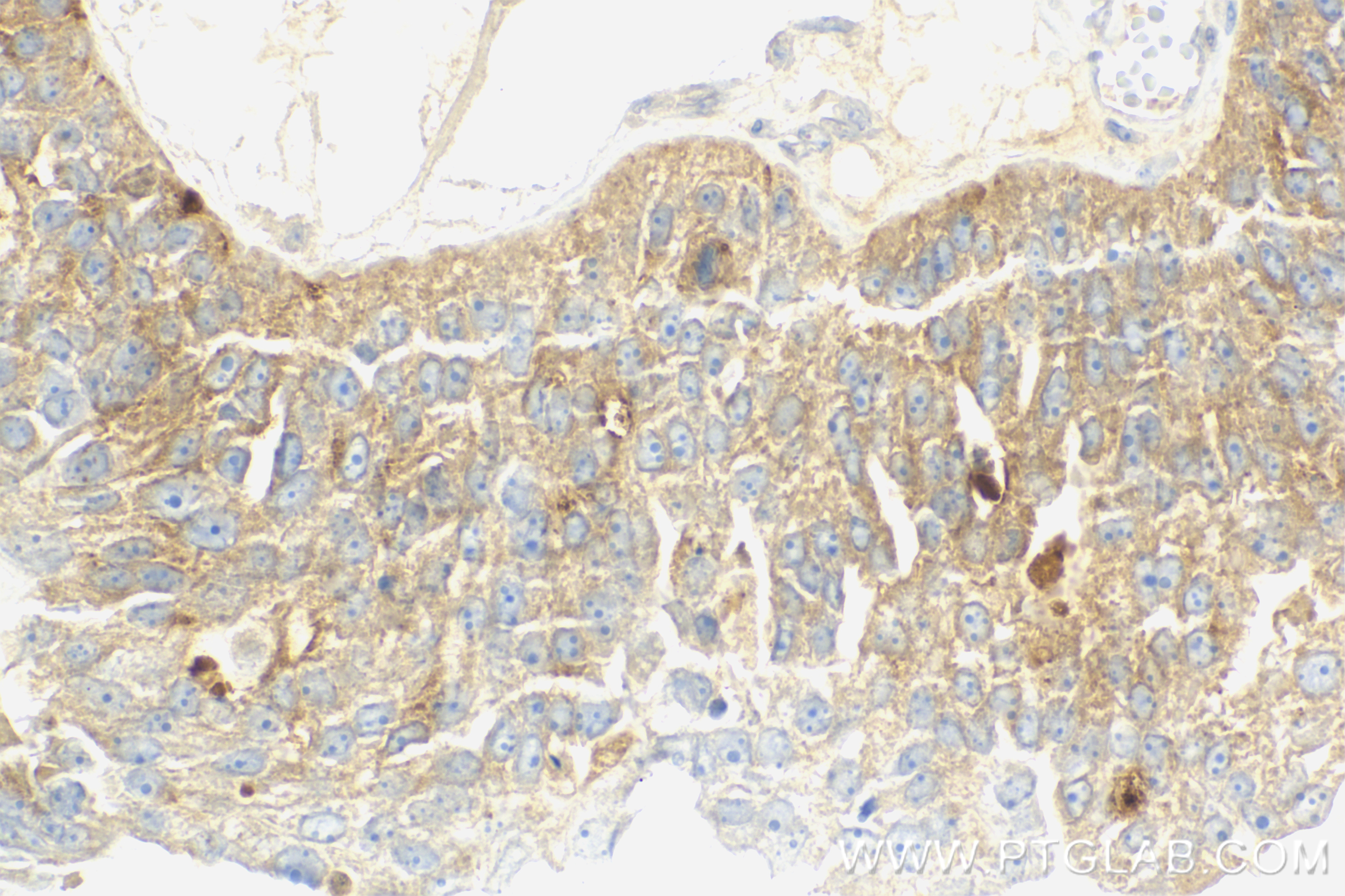 IHC staining of human ovary cancer using 83685-4-RR