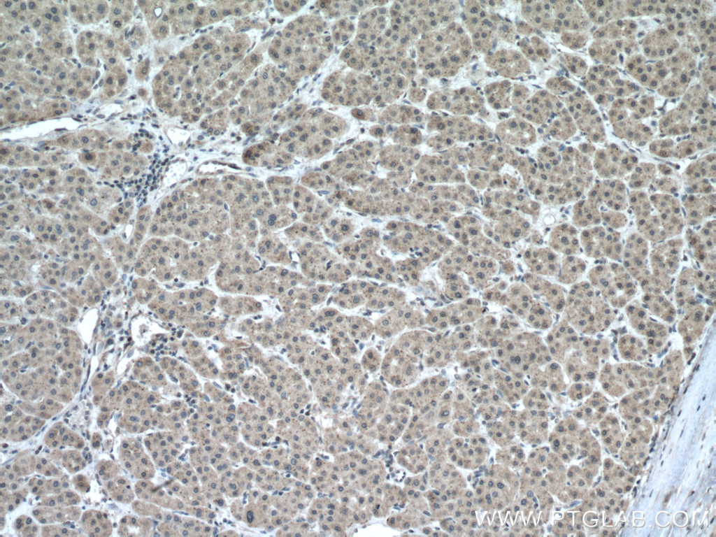 IHC staining of human liver cancer using 10477-1-AP