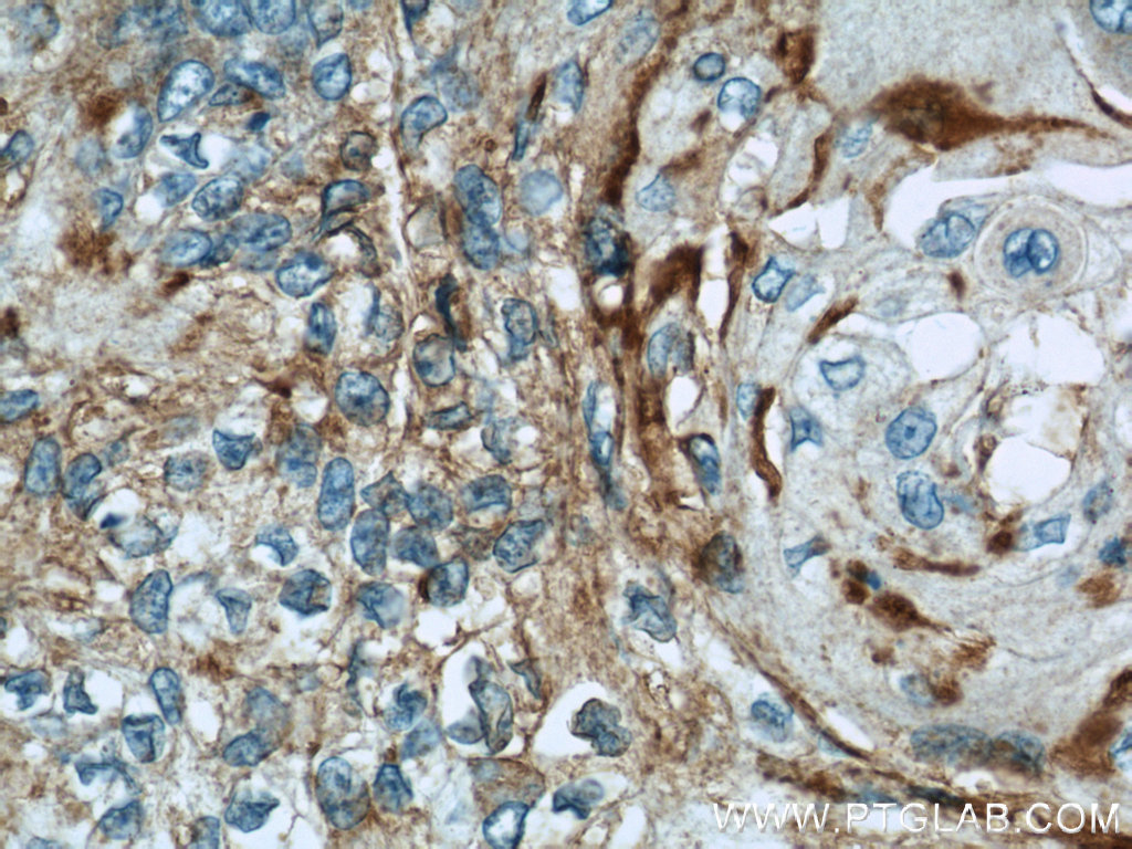 IHC staining of human oesophagus cancer using 13683-1-AP