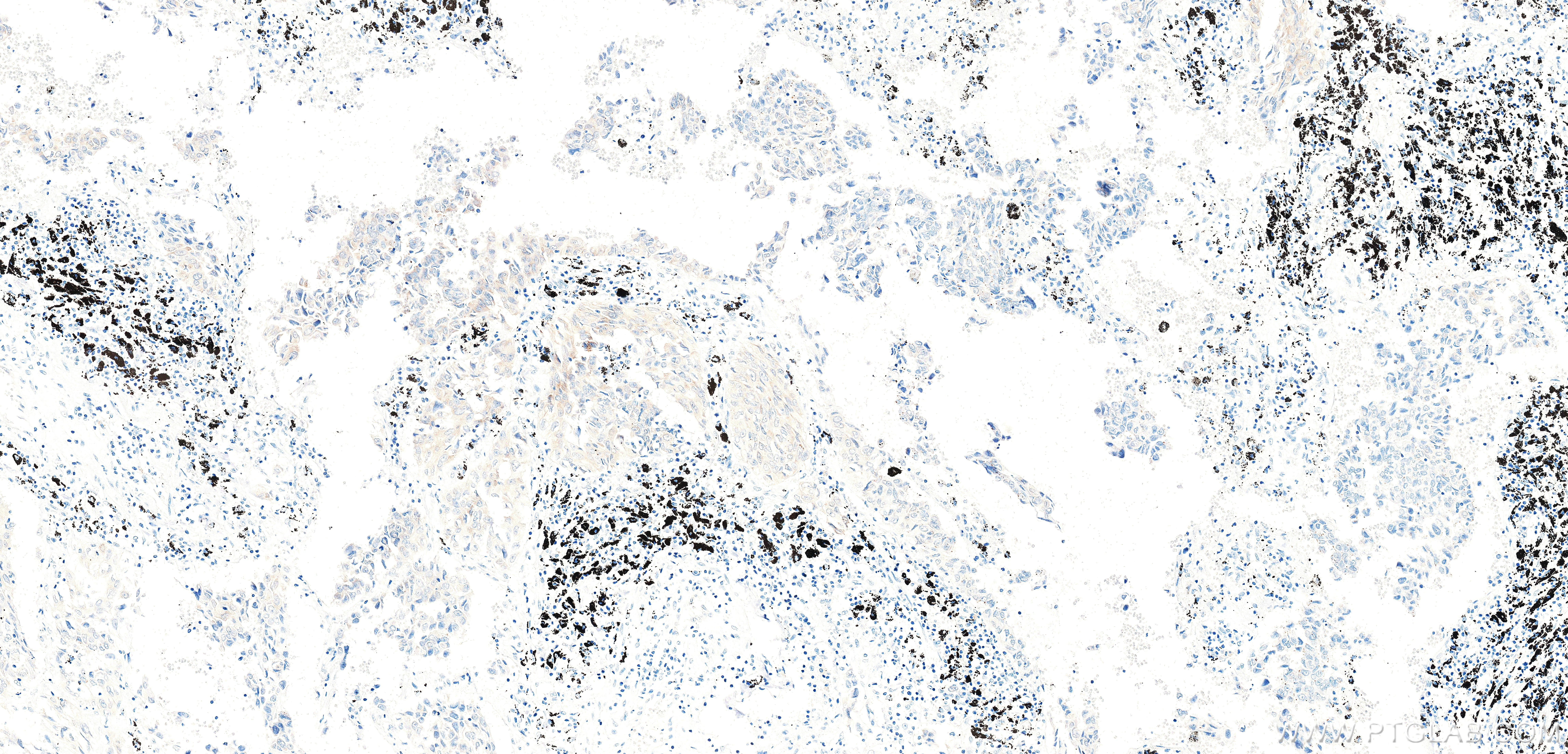 IHC staining of Human lung cancer （Adenocarcinoma） using 87800-1-RR (same clone as 87800-1-PBS)