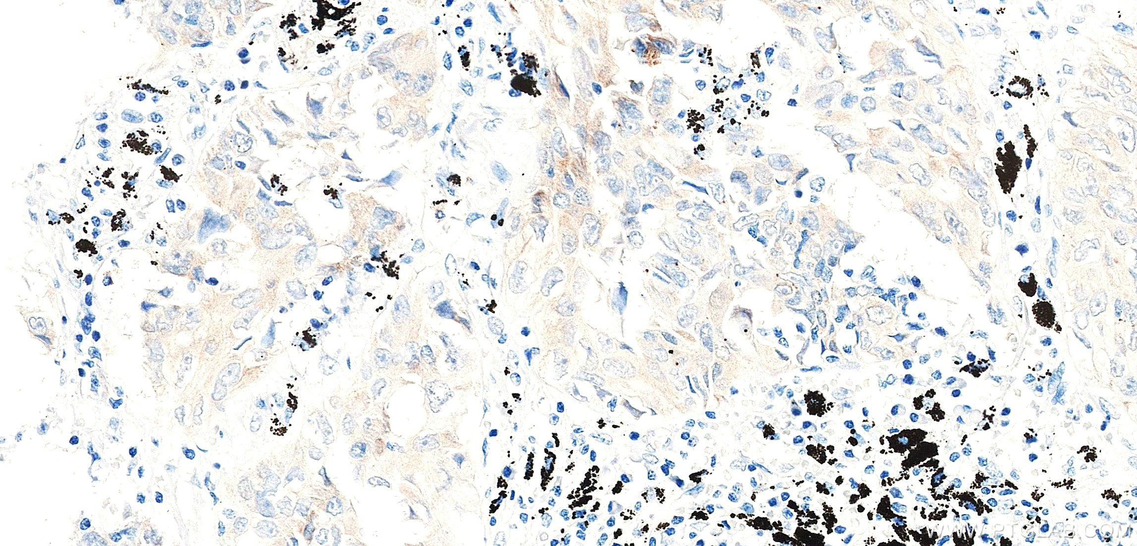 IHC staining of Human lung cancer （Adenocarcinoma） using 87800-1-RR (same clone as 87800-1-PBS)