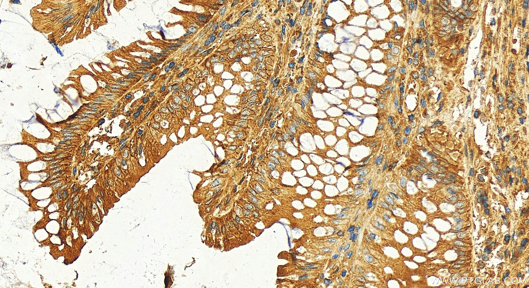 IHC staining of human colon  cancer using 16278-1-AP