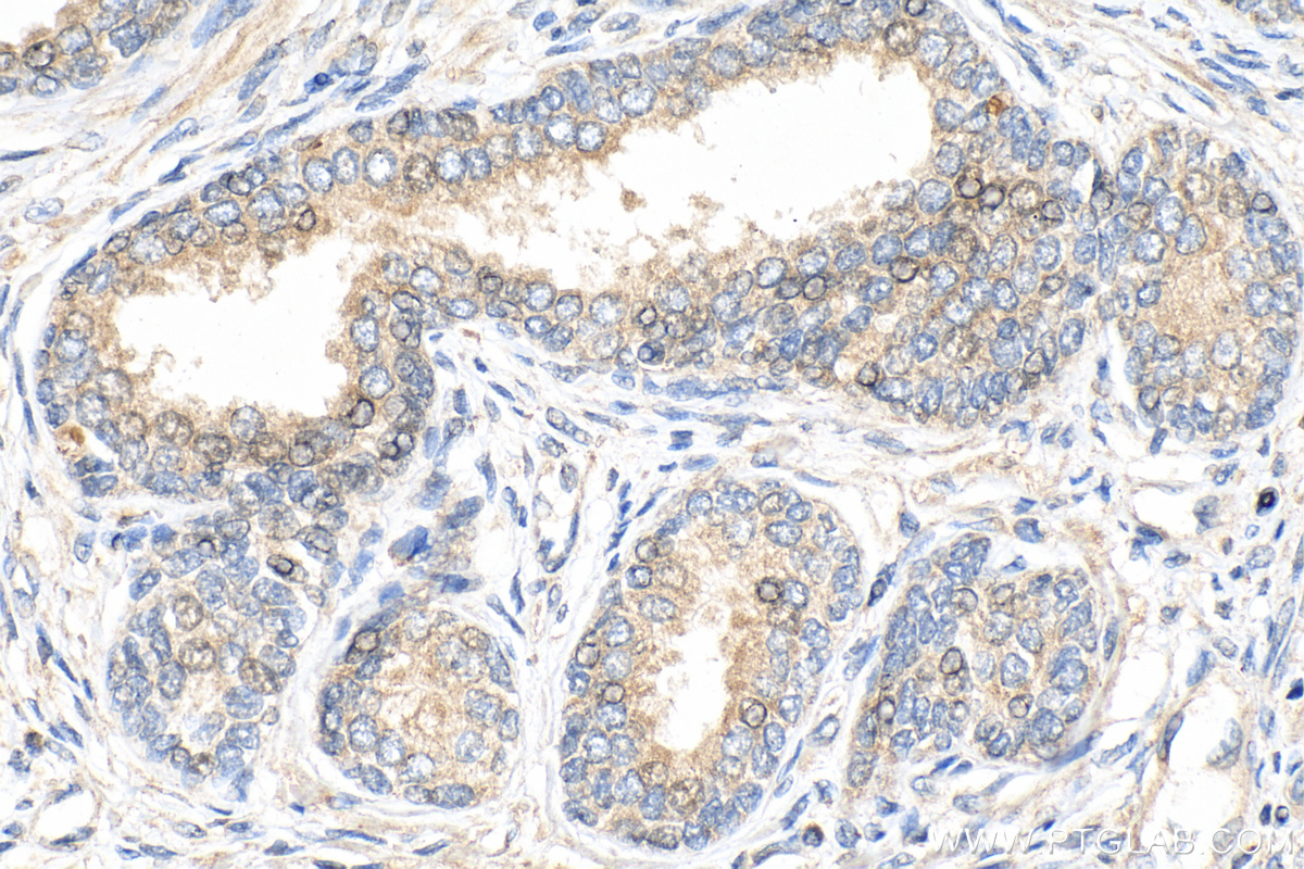 IHC staining of human prostate cancer using 68406-1-Ig