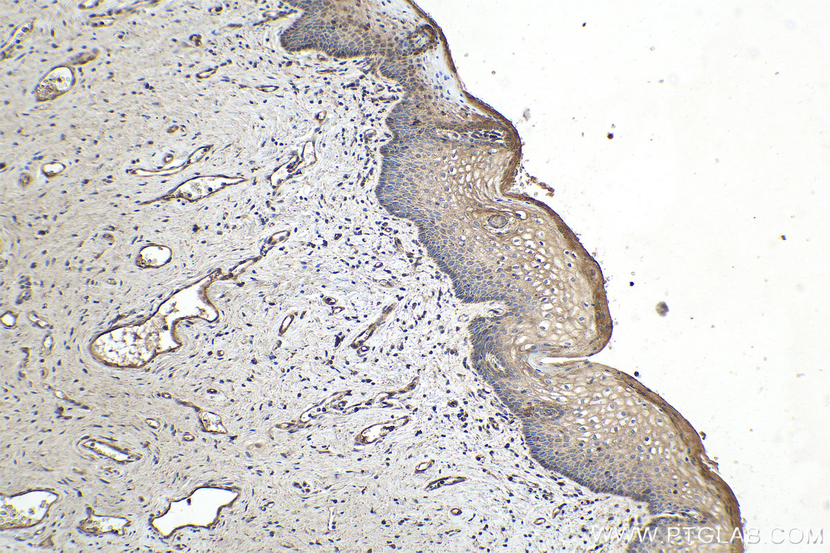 IHC staining of human cervical cancer using 66741-1-Ig (same clone as 66741-1-PBS)