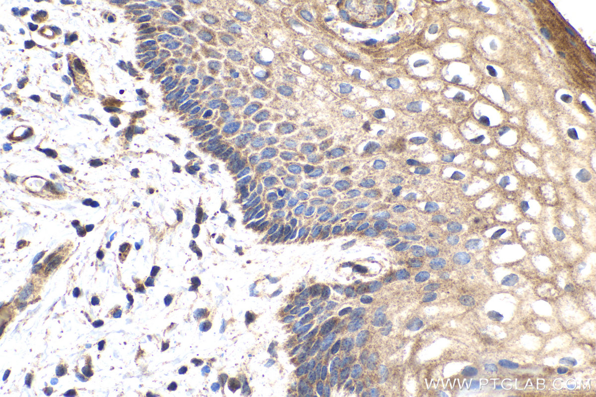 IHC staining of human cervical cancer using 66741-1-Ig (same clone as 66741-1-PBS)