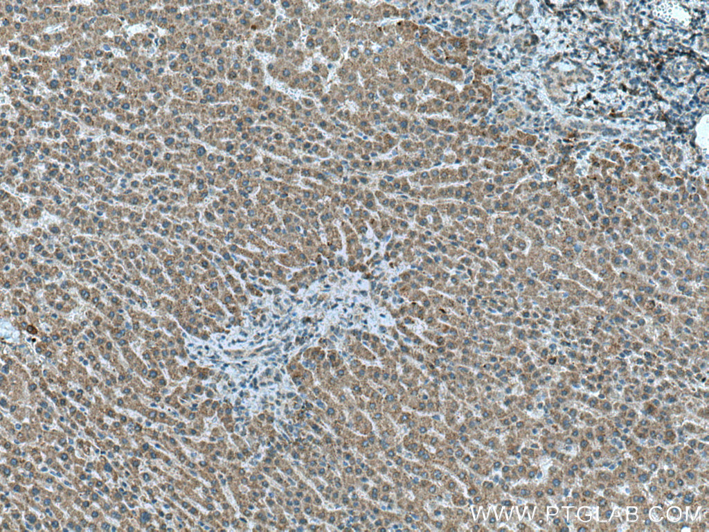 IHC staining of human liver cancer using 27293-1-AP