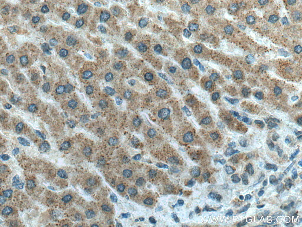 IHC staining of human liver cancer using 27293-1-AP