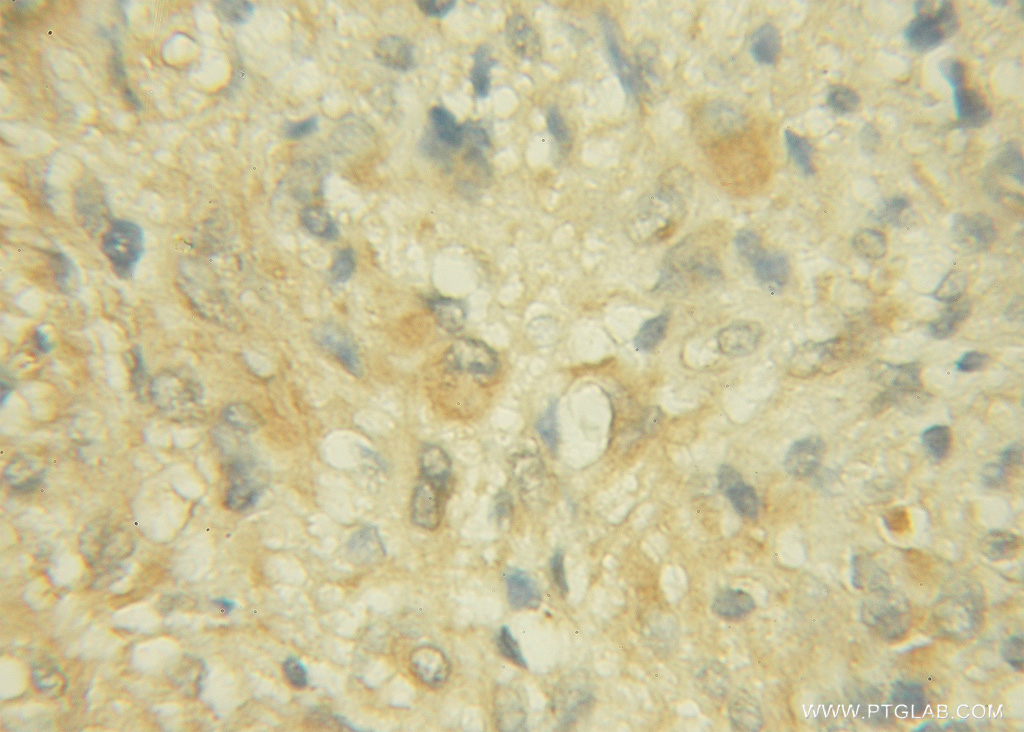 IHC staining of human gliomas using 12013-1-AP