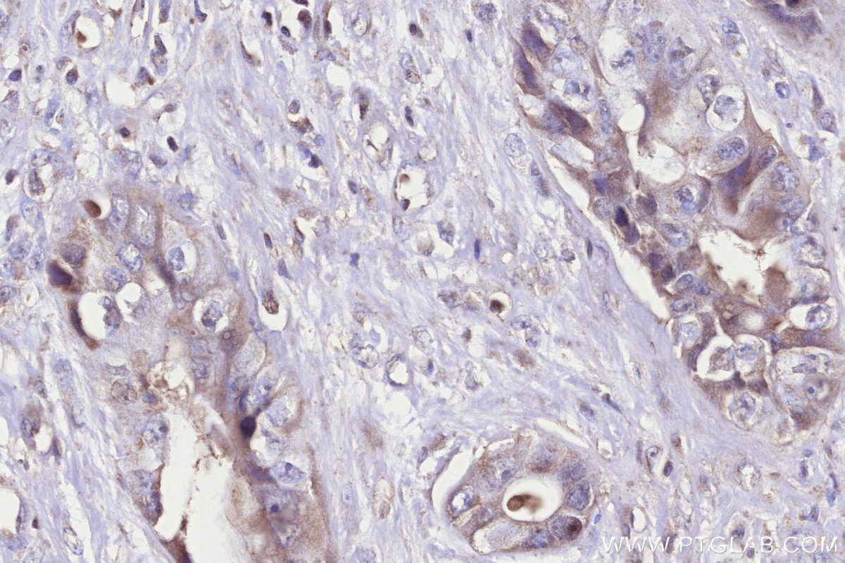 IHC staining of human pancreas cancer using 66623-1-Ig
