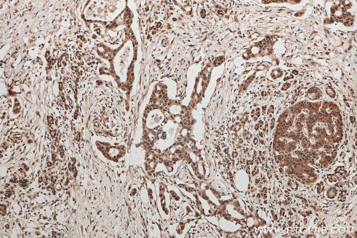 IHC staining of human pancreas cancer using 10209-2-AP