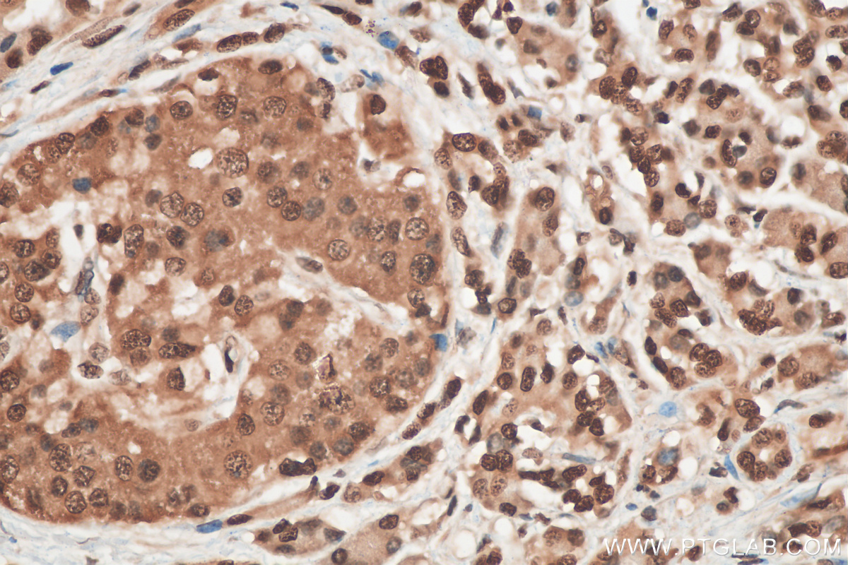 IHC staining of human pancreas cancer using 10209-2-AP