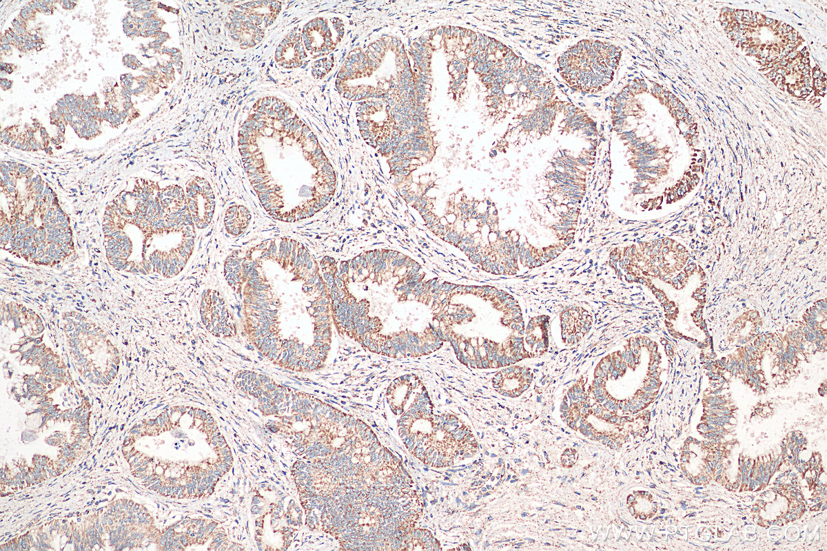 IHC staining of human pancreas cancer using 68030-1-Ig