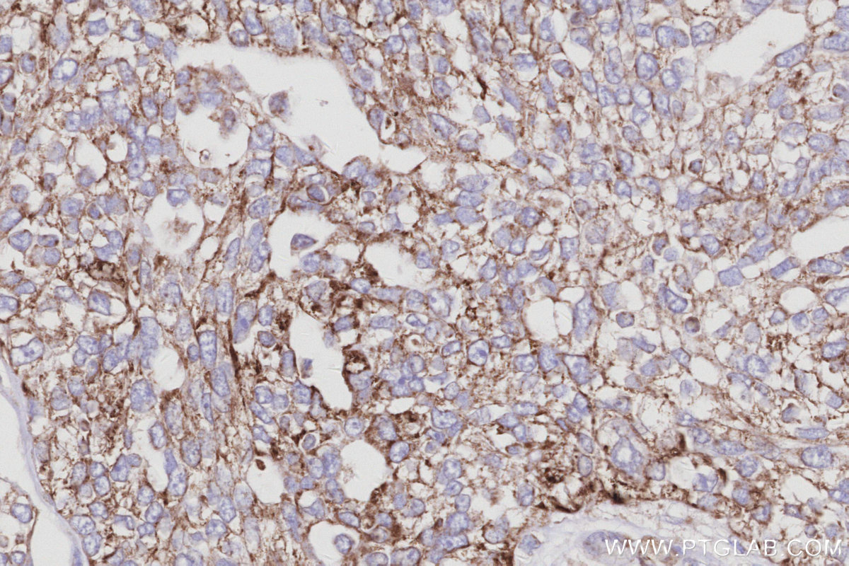 IHC staining of human ovary cancer using 68030-1-Ig