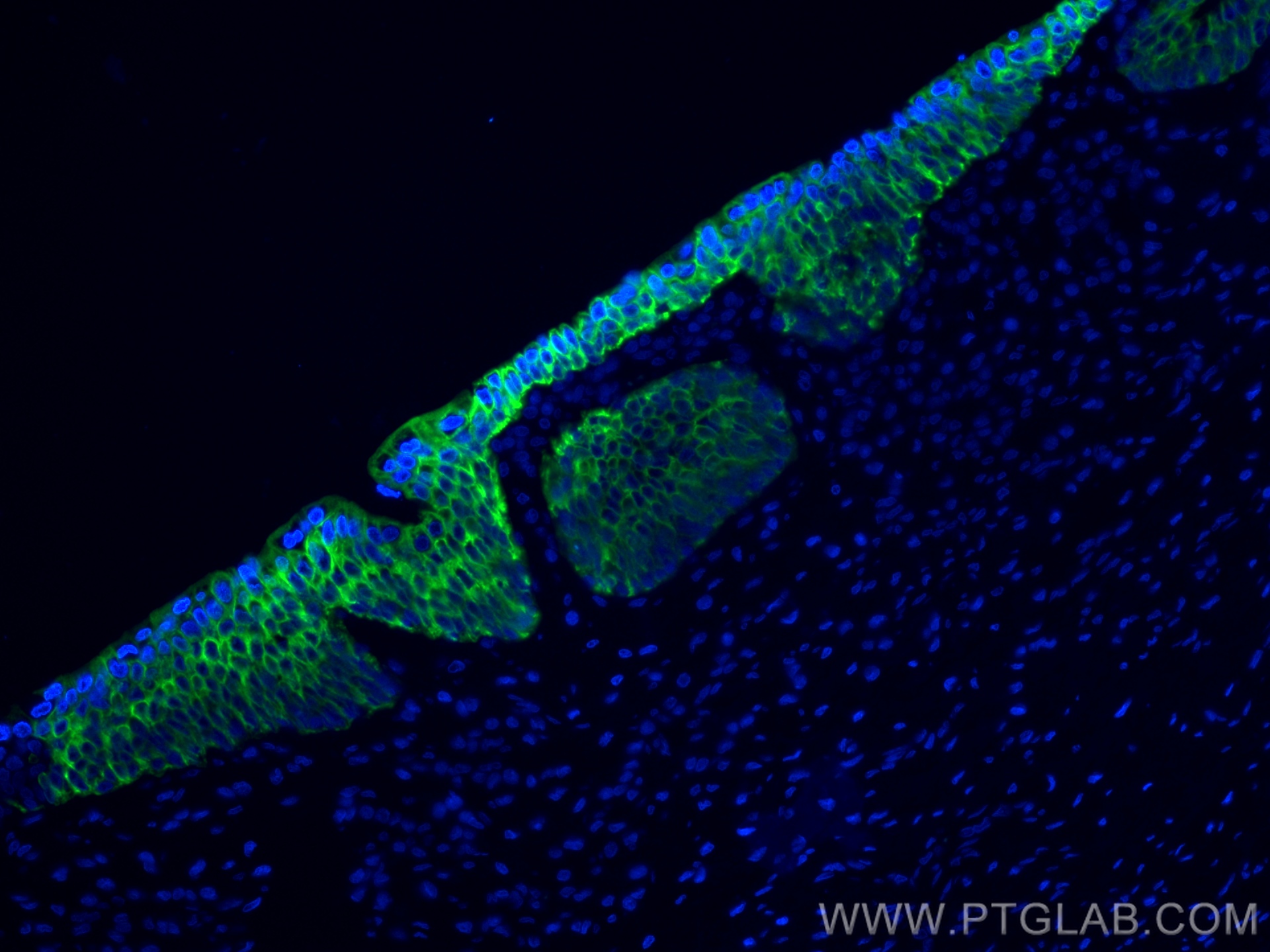 IF Staining of human prostate cancer using 66483-1-Ig
