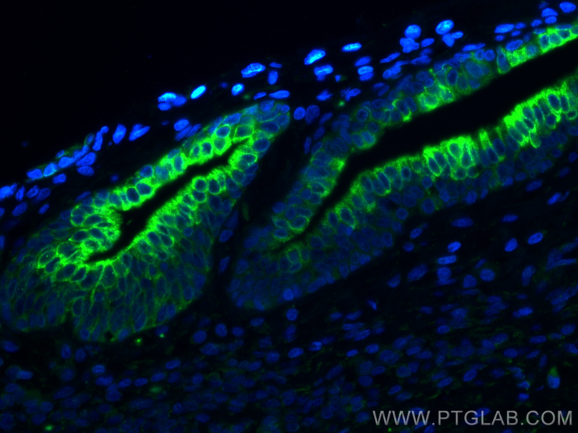 IF Staining of human prostate cancer using 66483-1-Ig