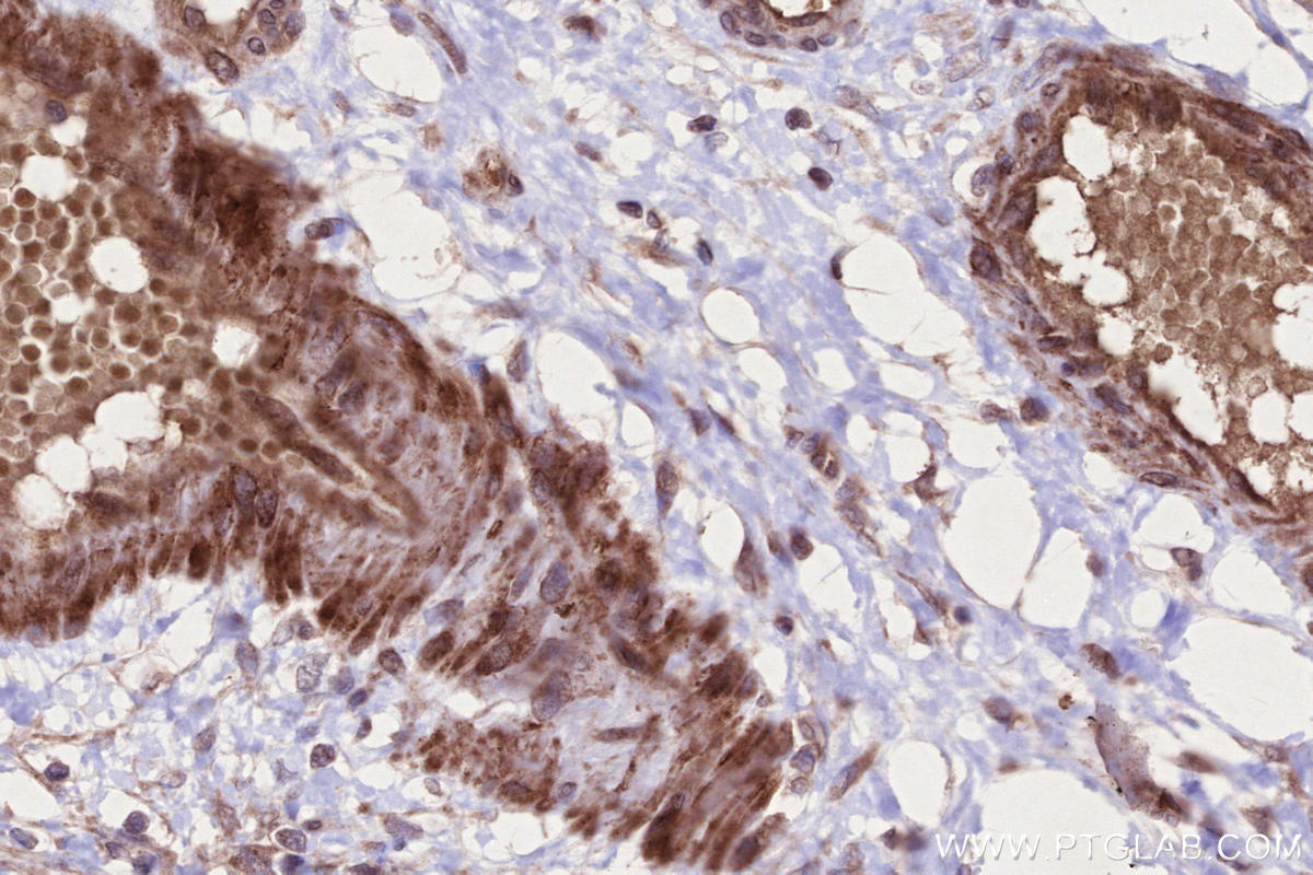 IHC staining of human ovary cancer using 17143-1-AP IHC staining of human ovary cancer using 17143-1-AP
