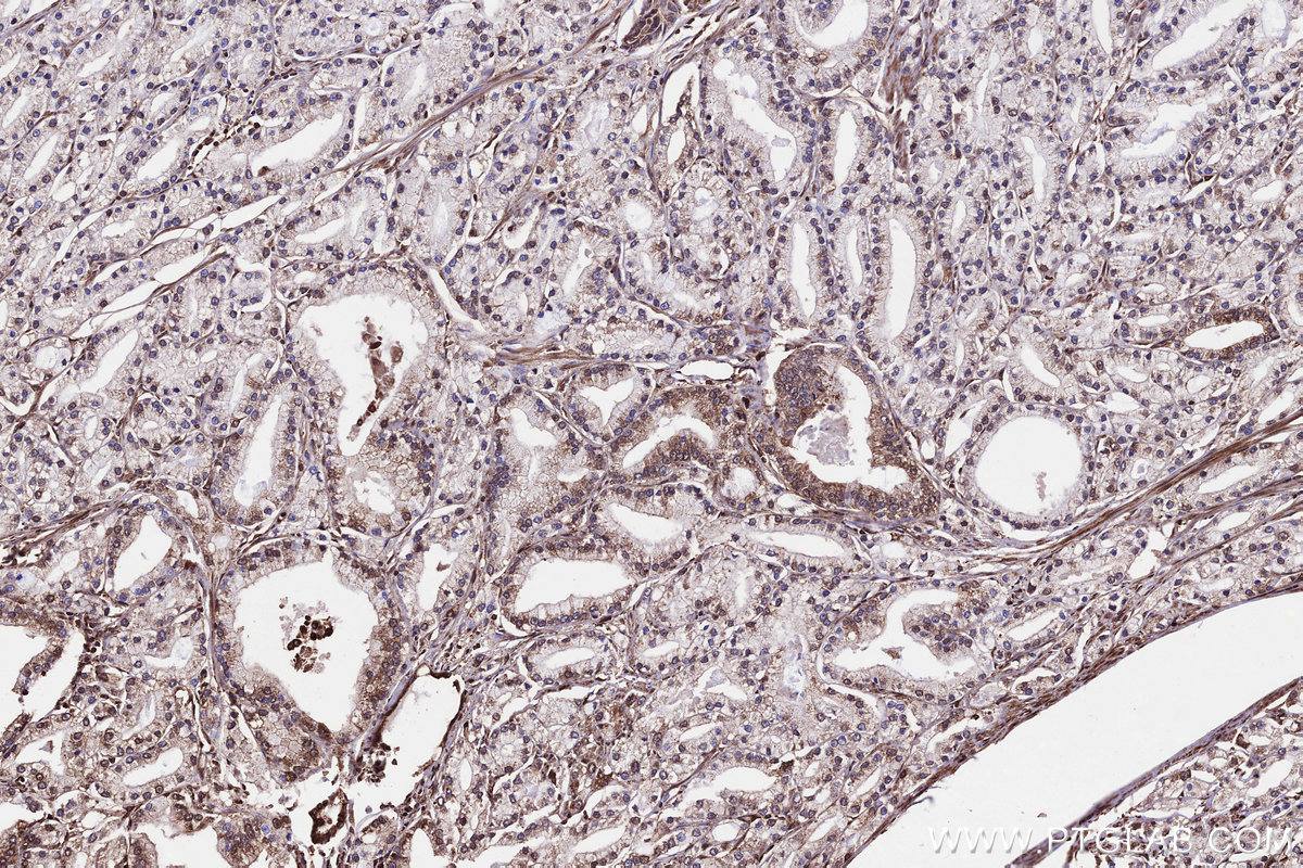 IHC staining of human prostate cancer using 29230-1-AP (same clone as 29230-1-PBS)