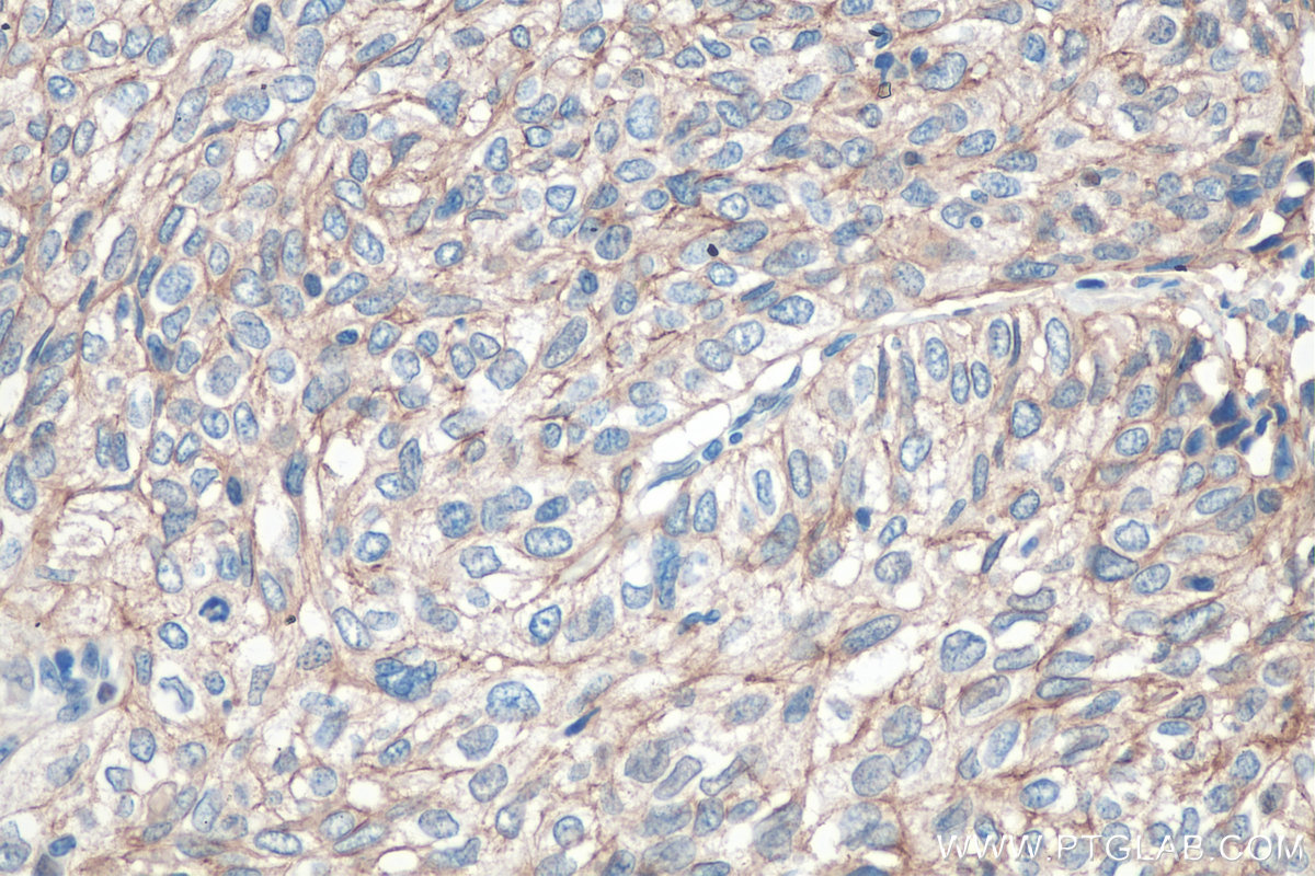 IHC staining of human cervical cancer using 13050-1-AP