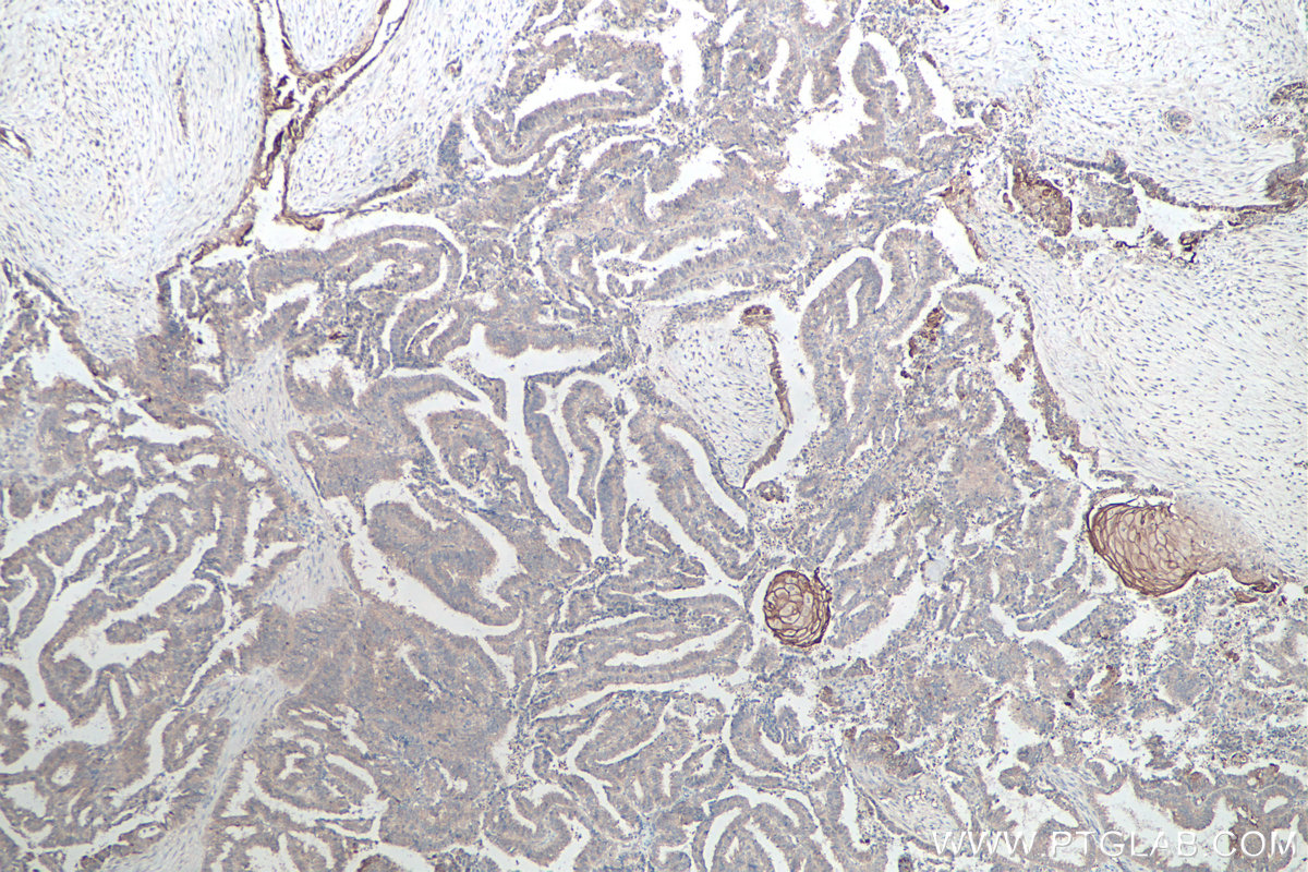 IHC staining of human ovary tumor using 66167-1-Ig IHC staining of human ovary tumor using 66167-1-Ig