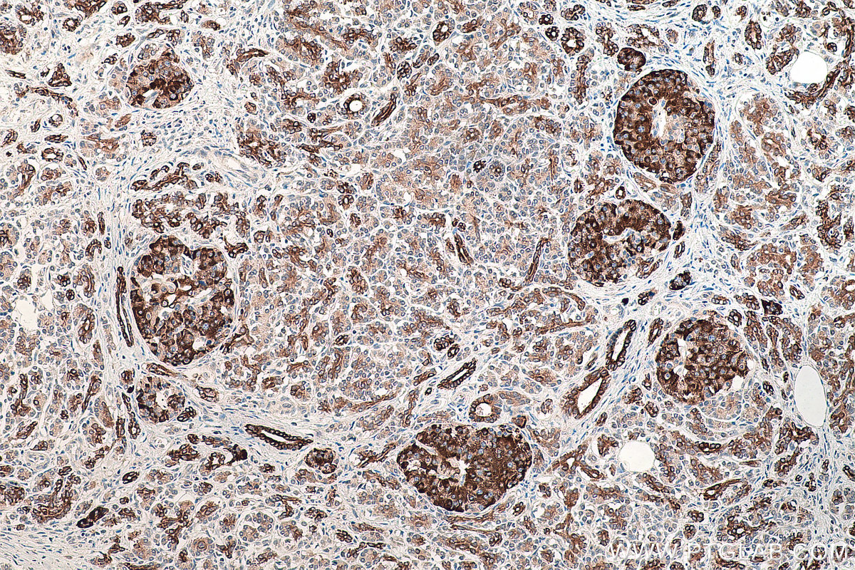 IHC staining of human pancreas cancer using 66167-1-Ig IHC staining of human pancreas cancer using 66167-1-Ig