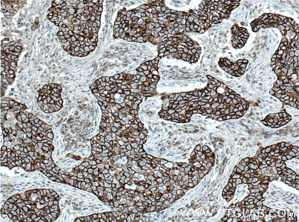 IHC staining of human breast cancer using 16195-1-AP