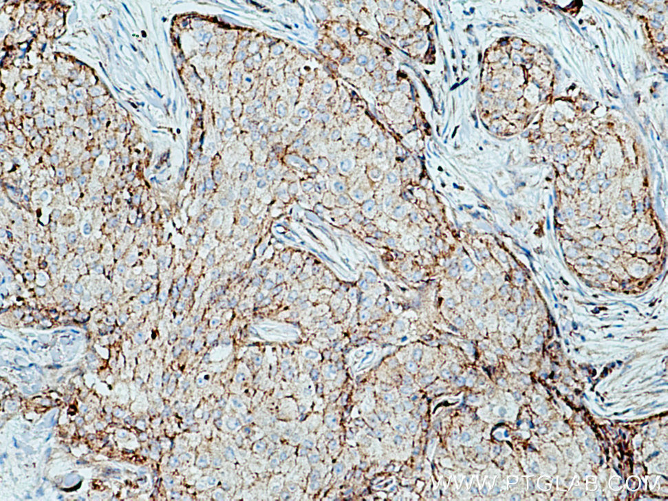 IHC staining of human breast cancer using 10118-1-AP