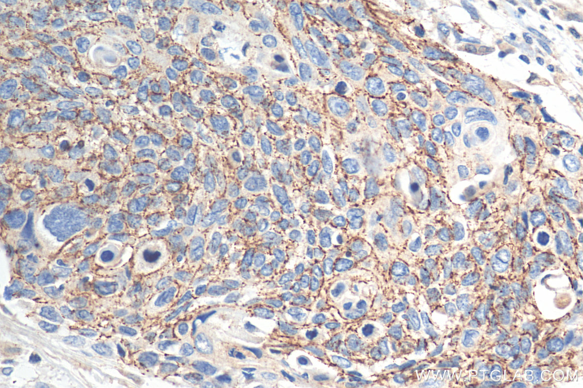 IHC staining of human oesophagus cancer using 29795-1-AP