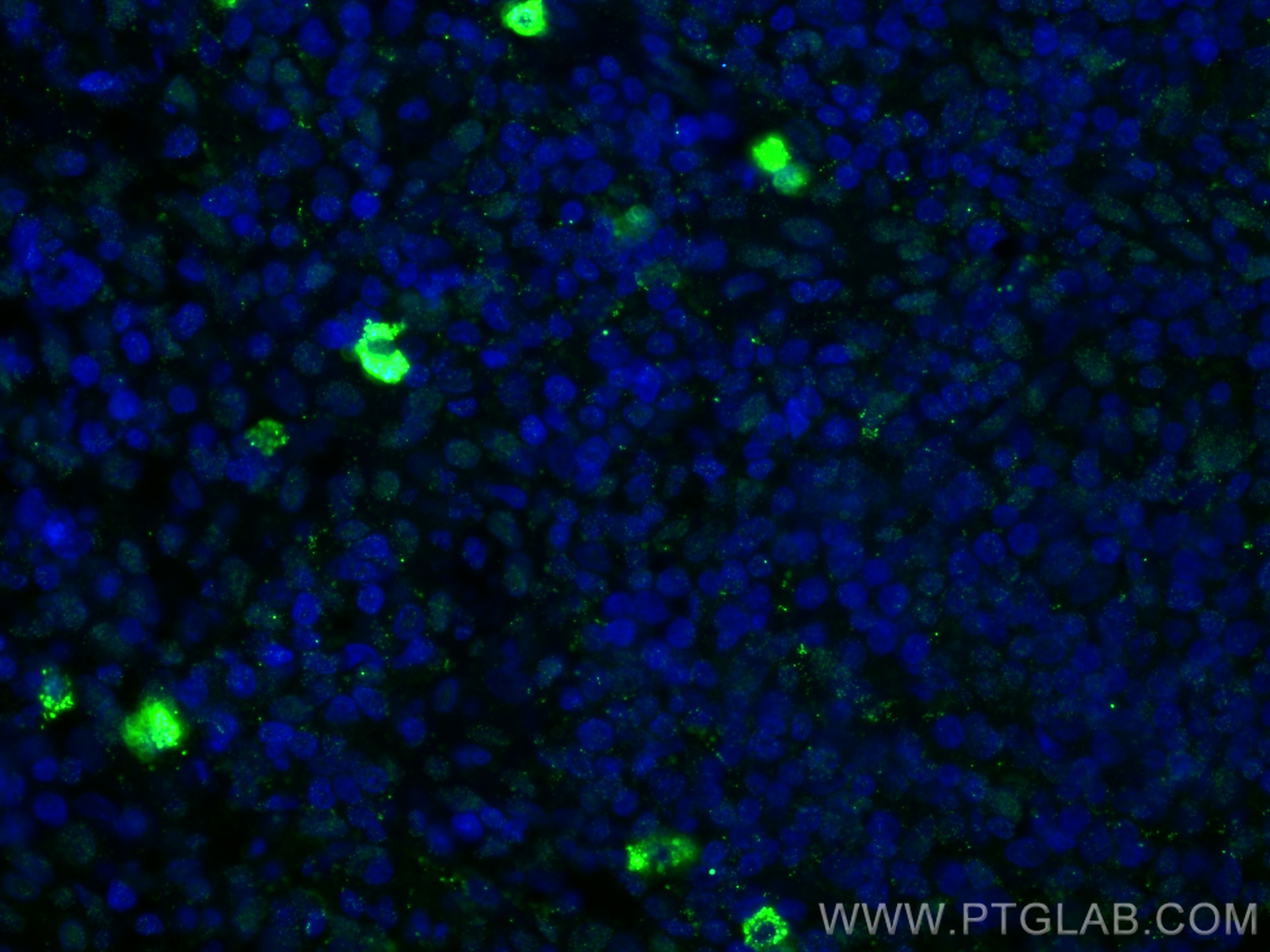 IF Staining of human lymphoma using 60295-1-Ig