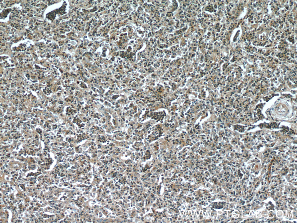 IHC staining of human lymphoma using 60295-1-Ig