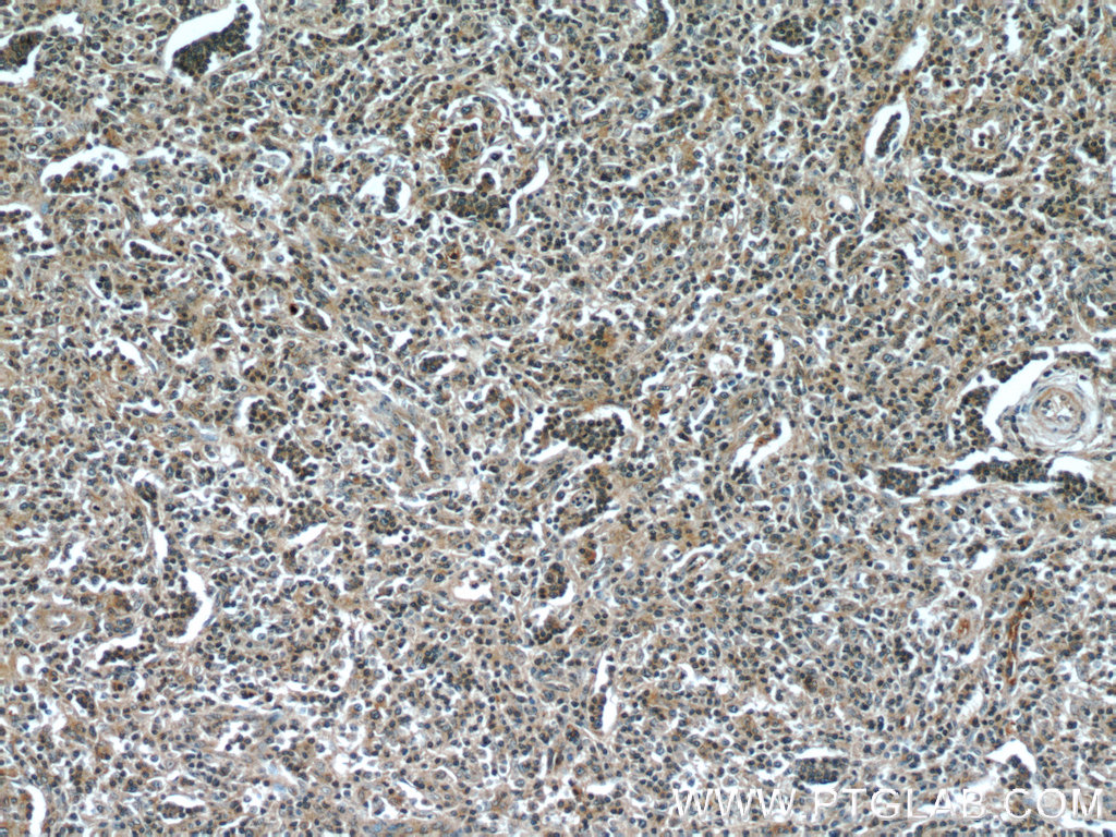 IHC staining of human lymphoma using 60295-1-Ig (same clone as 60295-1-PBS)