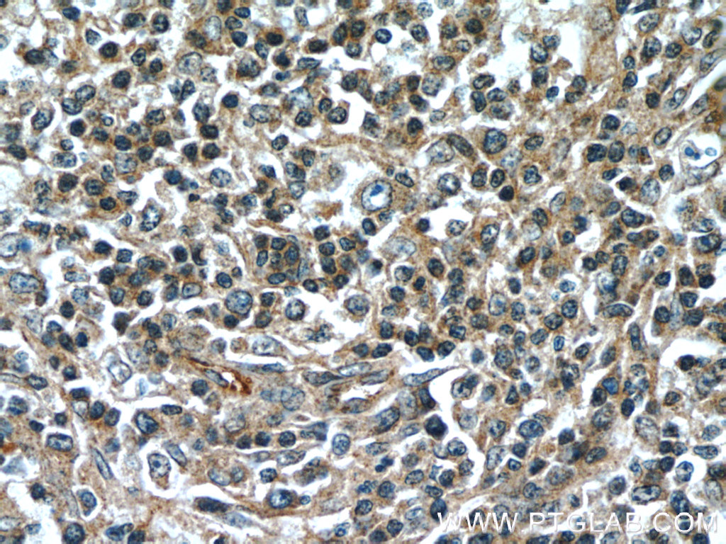 IHC staining of human lymphoma using 60295-1-Ig (same clone as 60295-1-PBS)