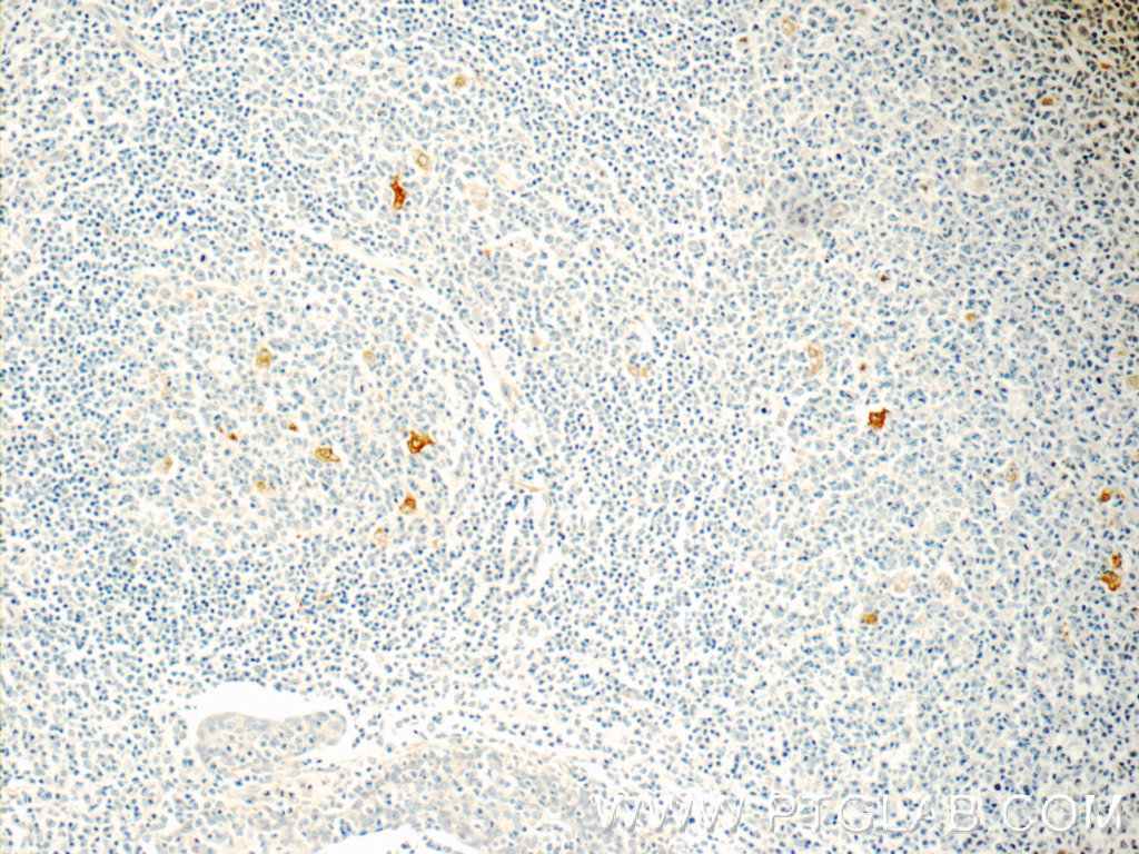 IHC staining of human tonsillitis using 18930-1-AP