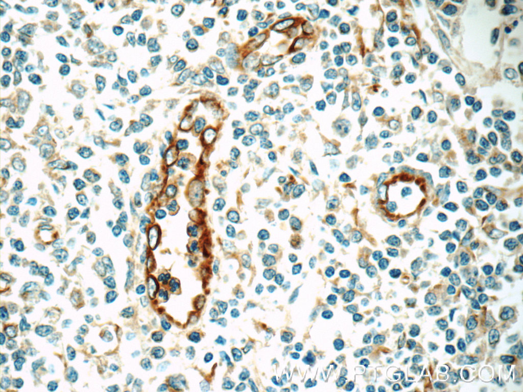 IHC staining of human tonsillitis using 22003-1-AP