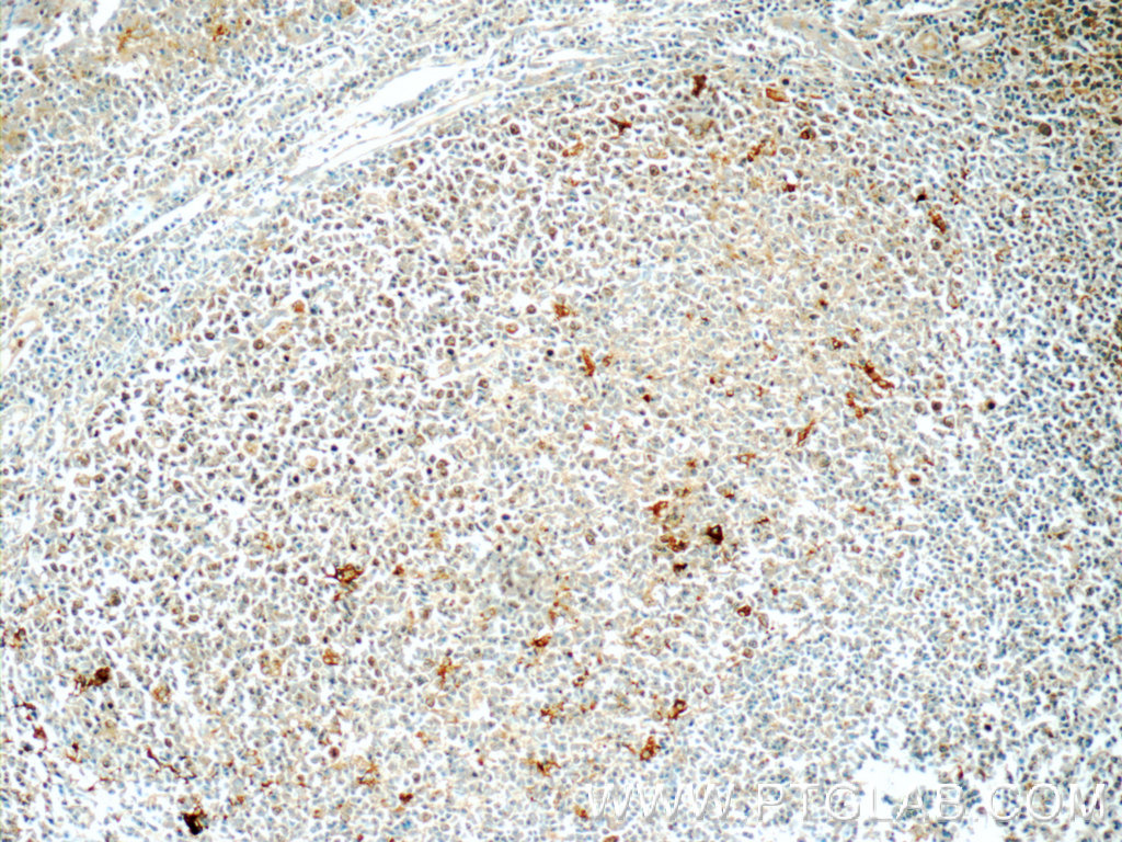 IHC staining of human tonsillitis using 55451-1-AP