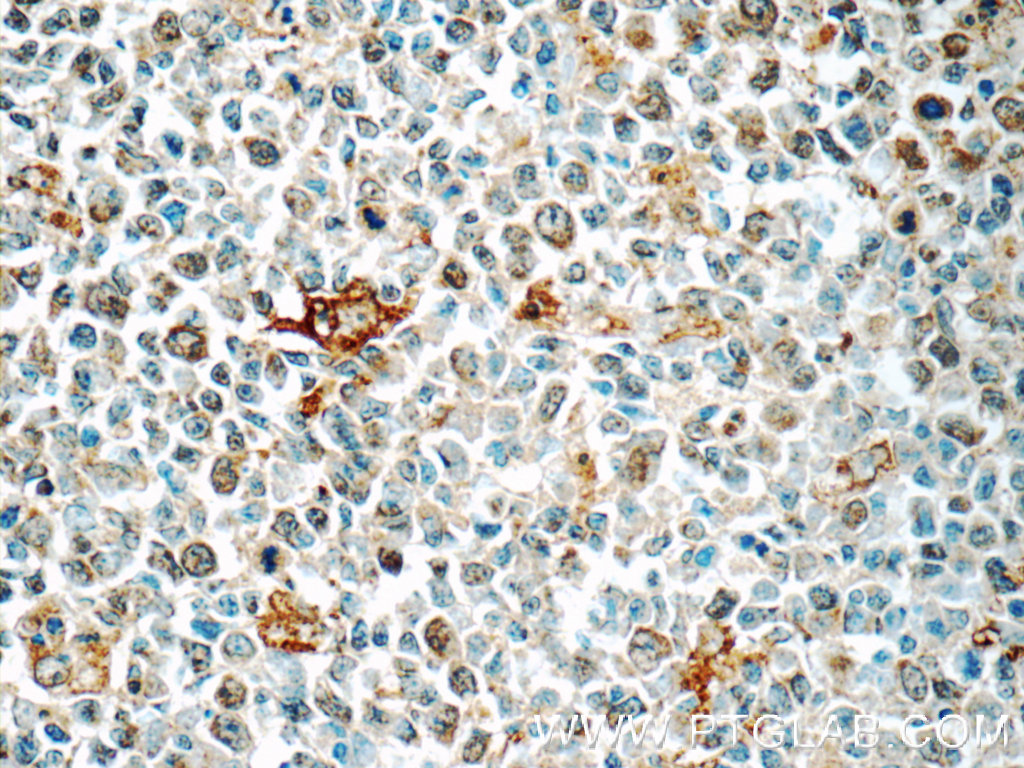 IHC staining of human tonsillitis using 55451-1-AP