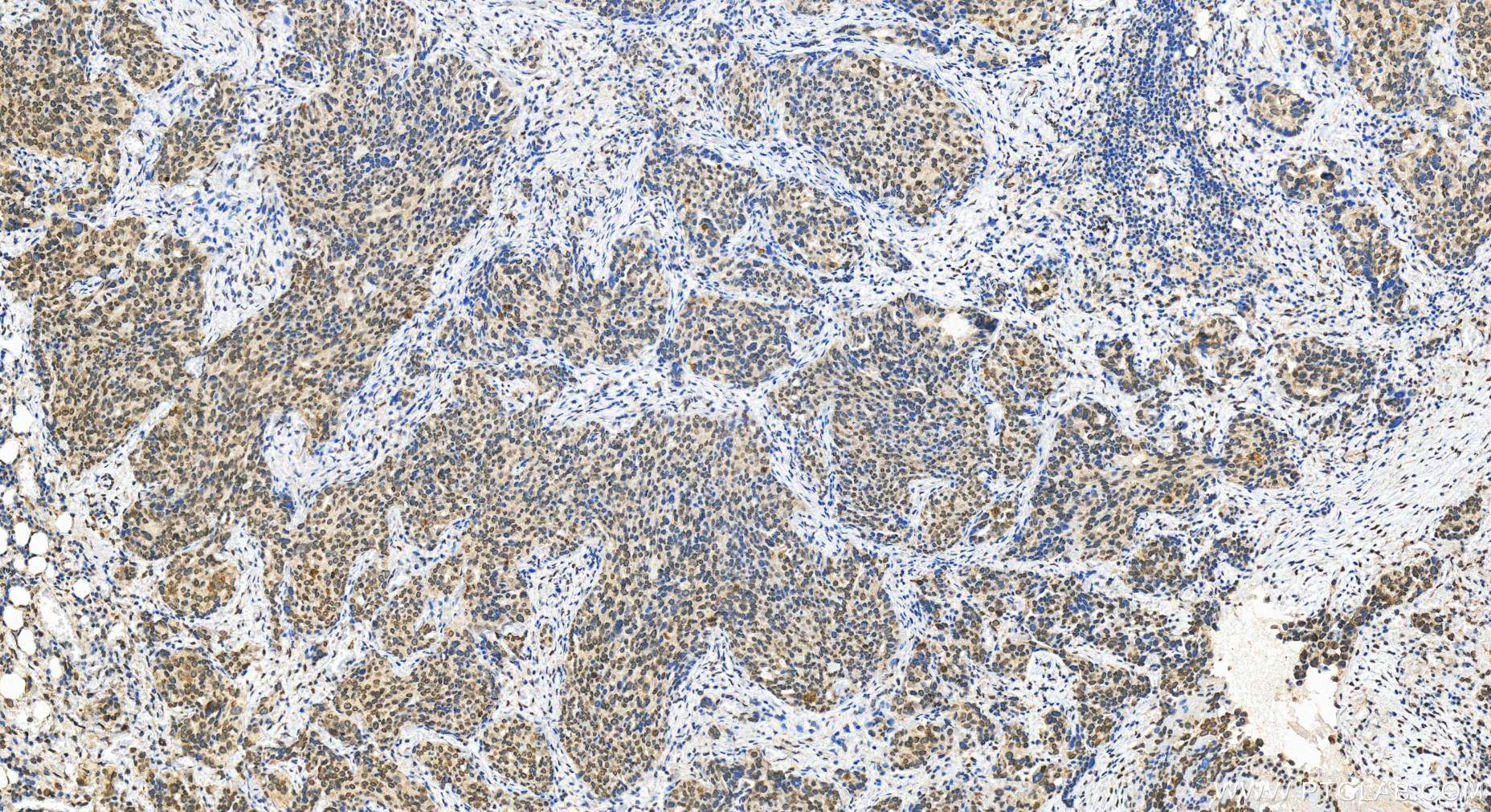 IHC staining of human ovary cancer using 28037-1-AP