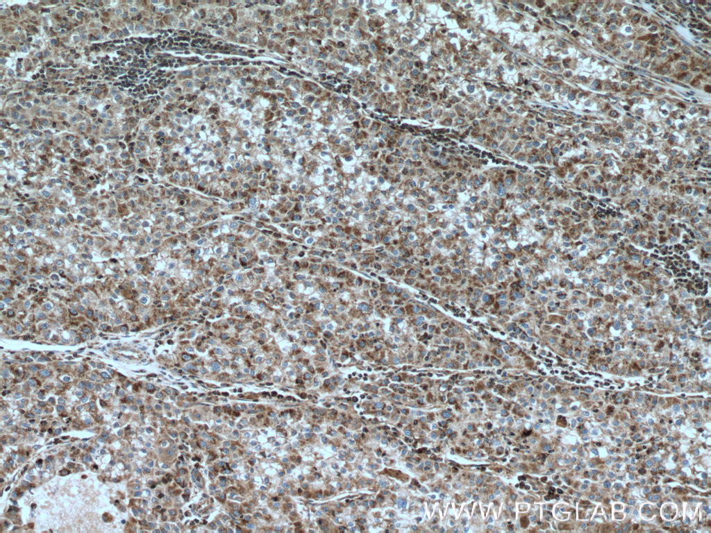 IHC staining of human liver cancer using 15698-1-AP