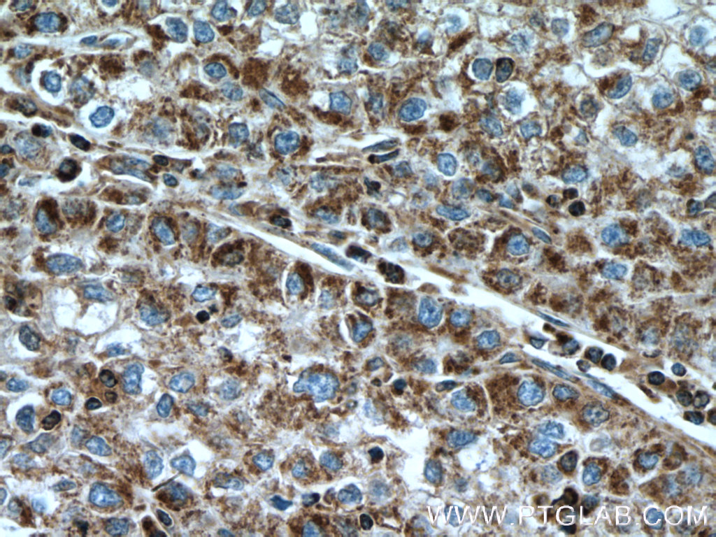 IHC staining of human liver cancer using 15698-1-AP