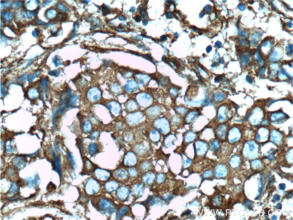 IHC staining of human breast cancer using 10852-1-AP