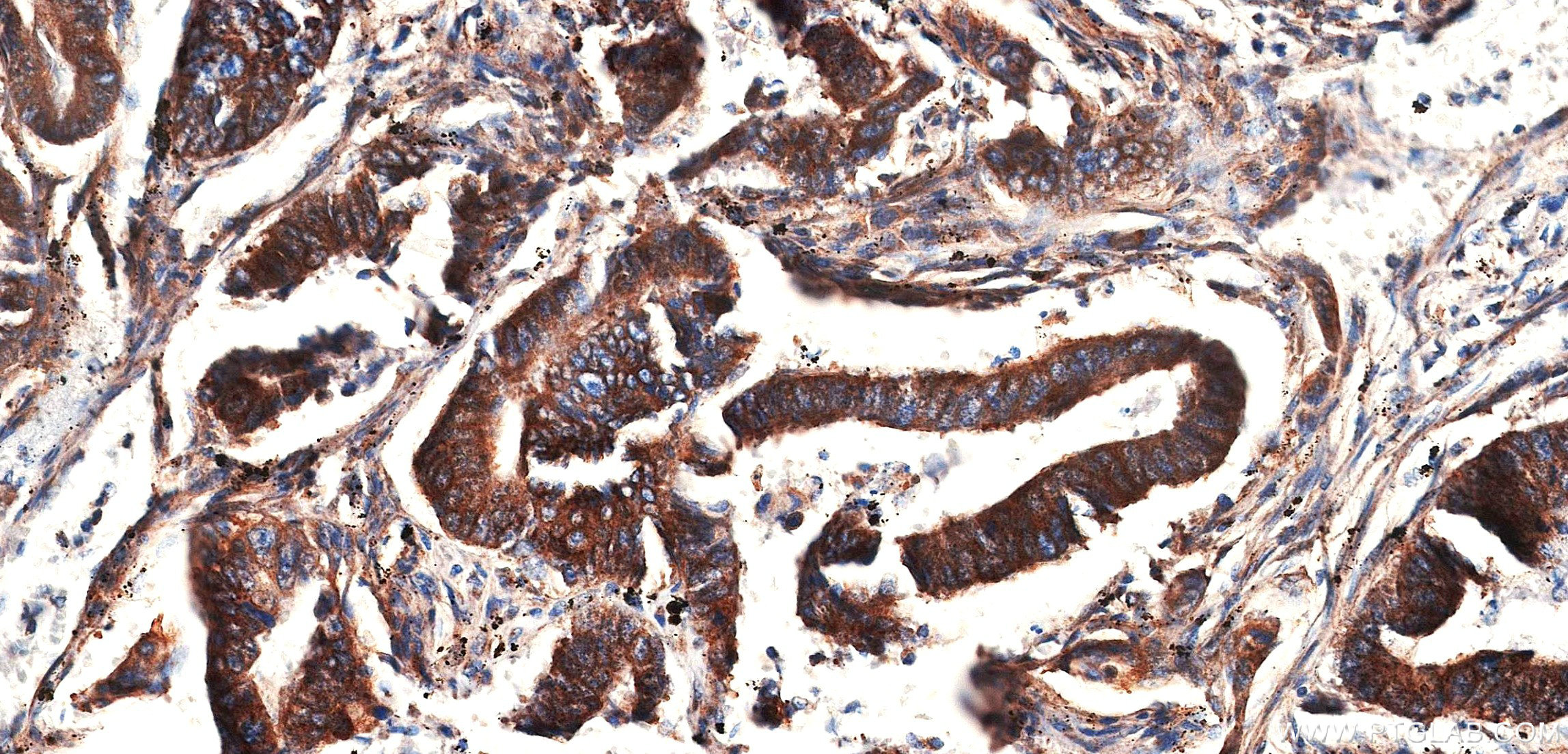 IHC staining of human colon cancer using 86660-3-RR IHC staining of human colon cancer using 86660-3-RR