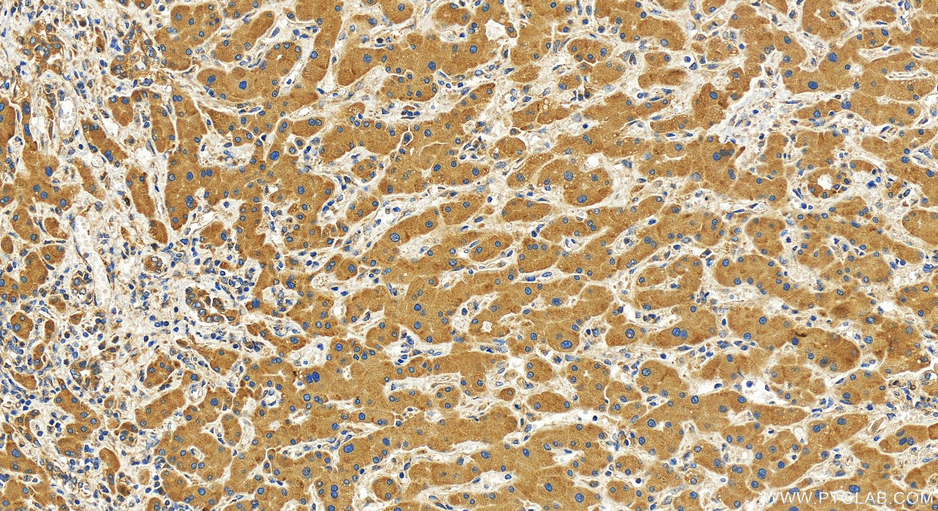 IHC staining of human intrahepatic cholangiocarcinoma using 31407-1-AP