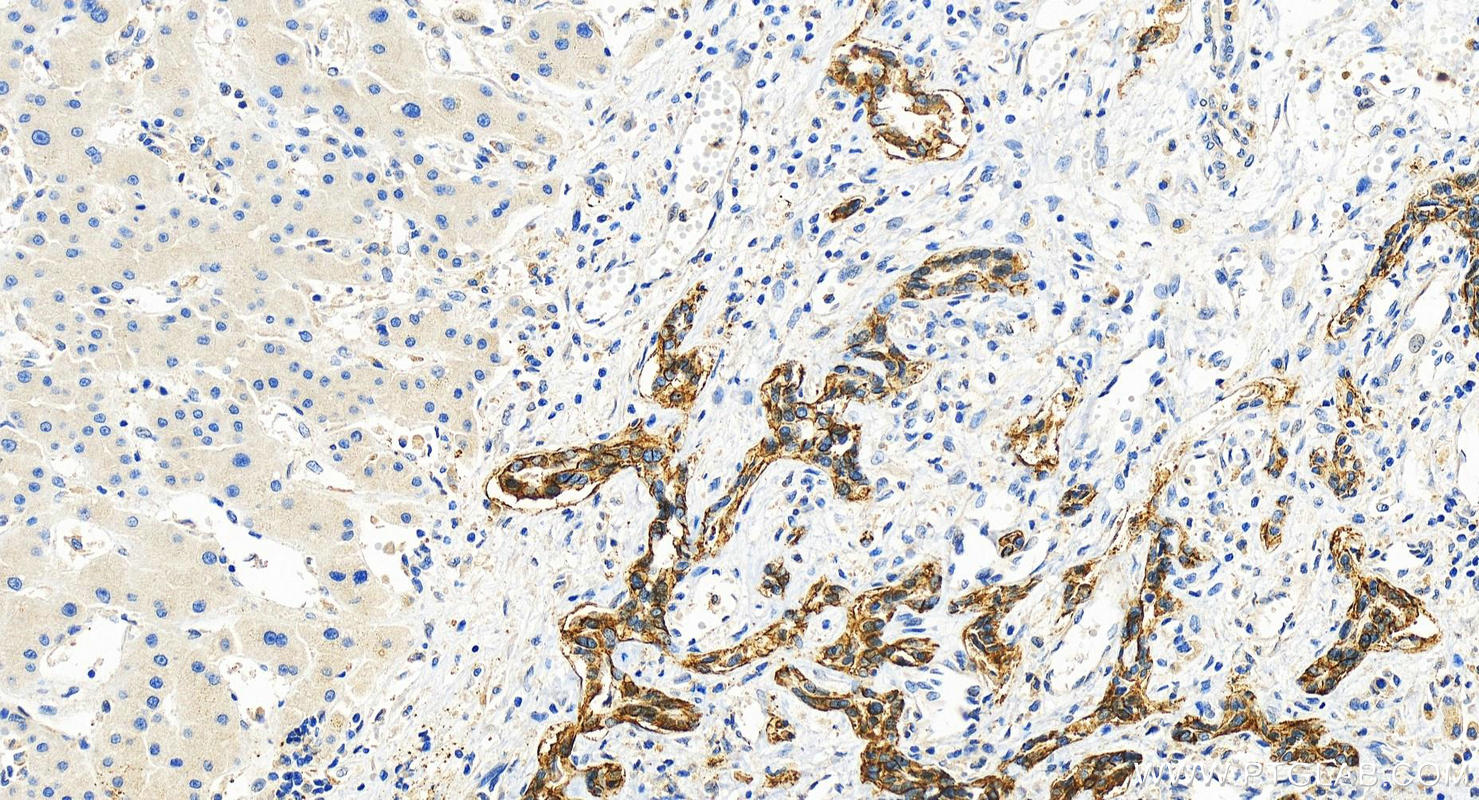 IHC staining of human intrahepatic cholangiocarcinoma using 83381-1-RR