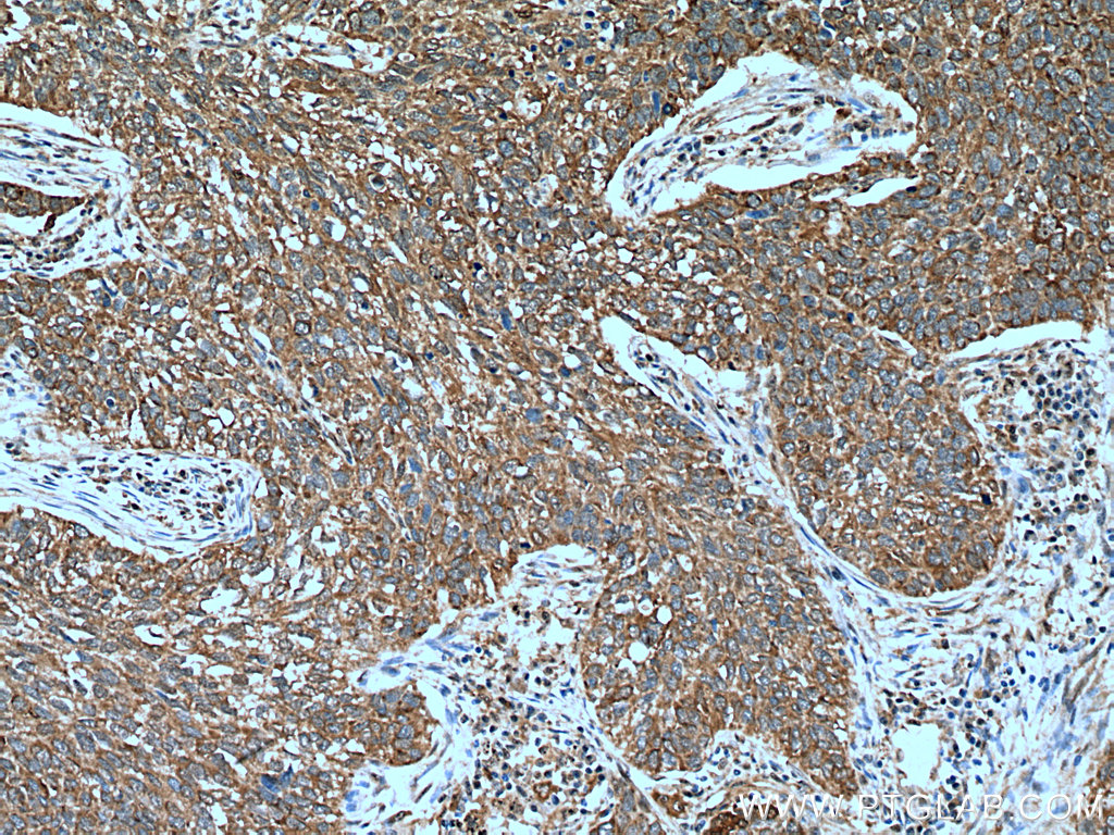 IHC staining of human lung cancer using 11360-1-AP