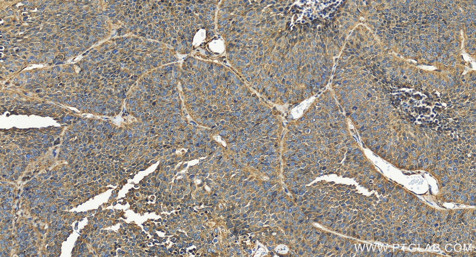 IHC staining of human lung cancer using 86475-1-RR (same clone as 86475-1-PBS)