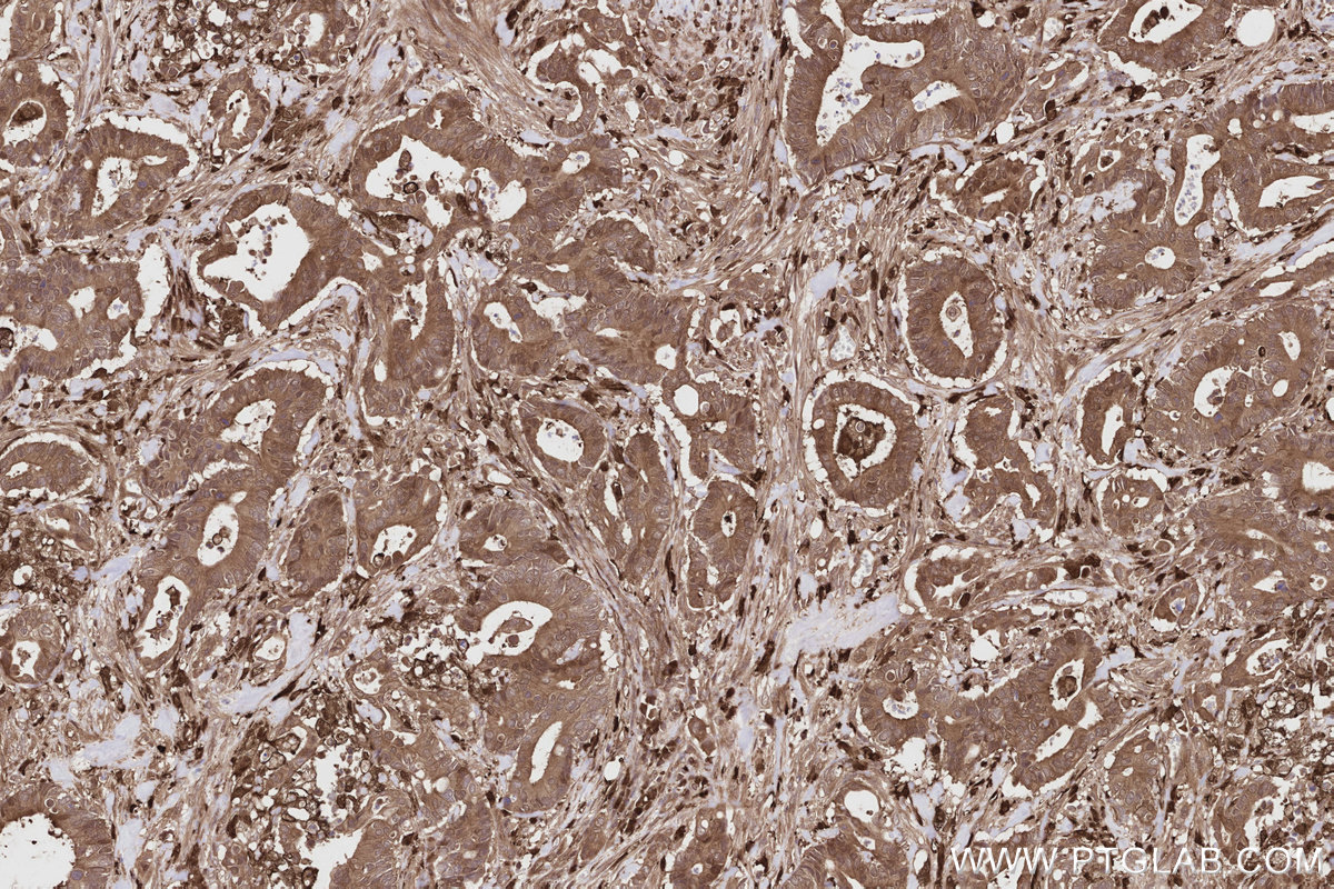 IHC staining of human rectal cancer using 84924-7-RR IHC staining of human rectal cancer using 84924-7-RR