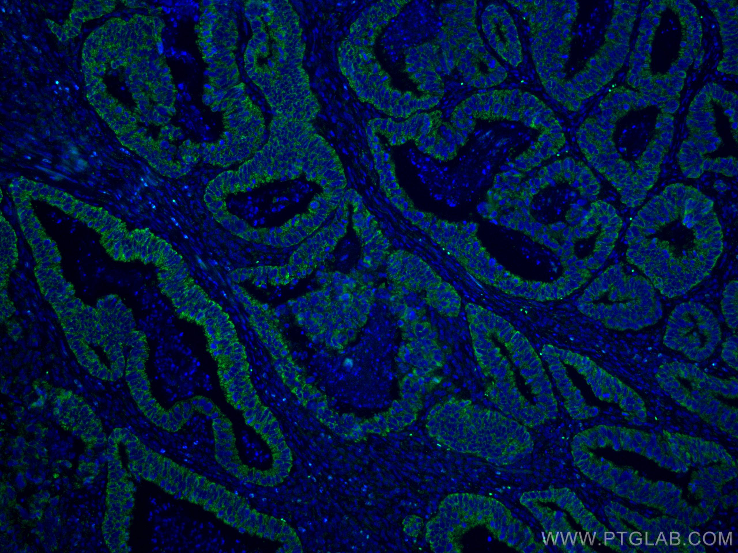 IF Staining of human colon cancer using 67798-1-Ig (same clone as 67798-1-PBS)