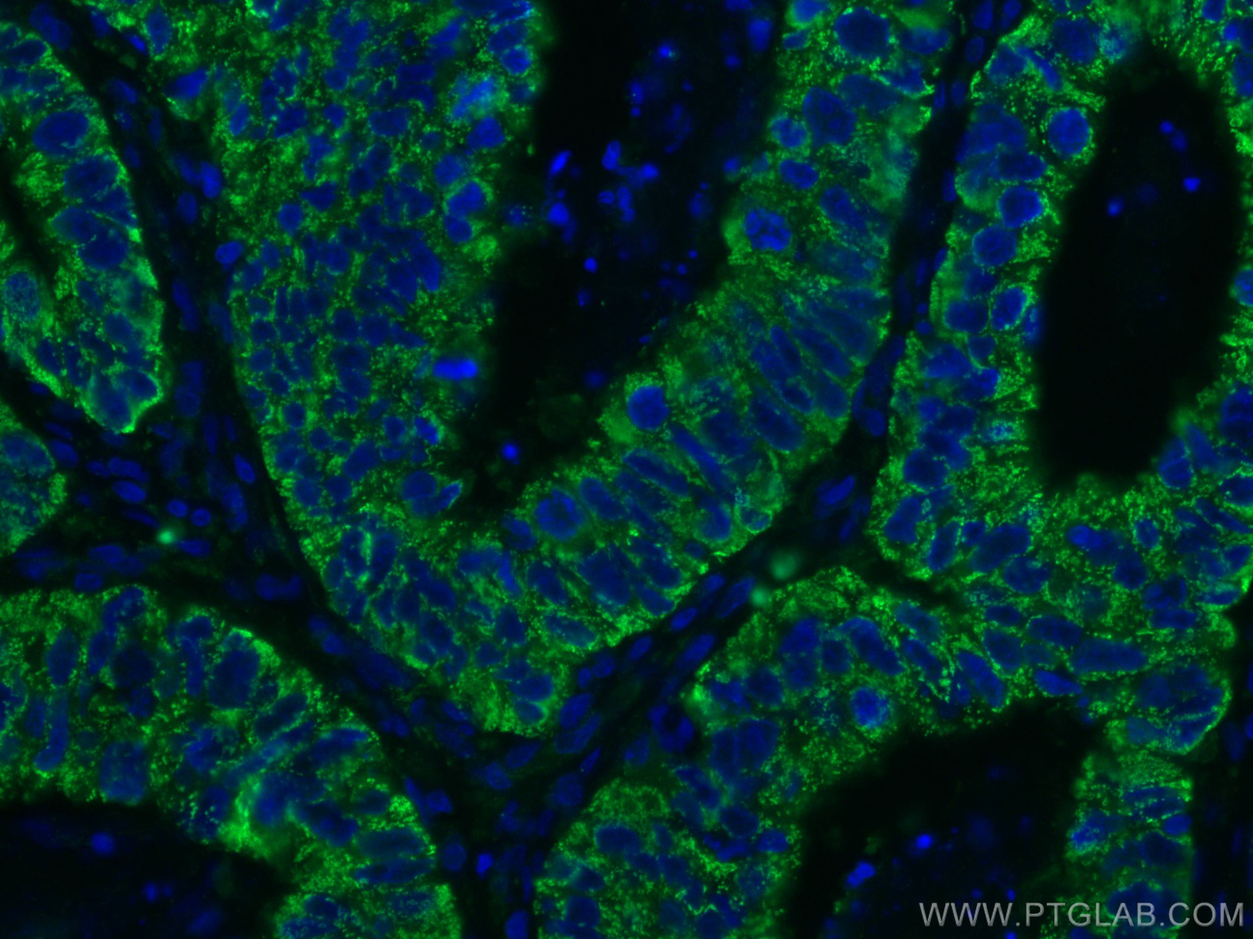IF Staining of human colon cancer using 67798-1-Ig (same clone as 67798-1-PBS)
