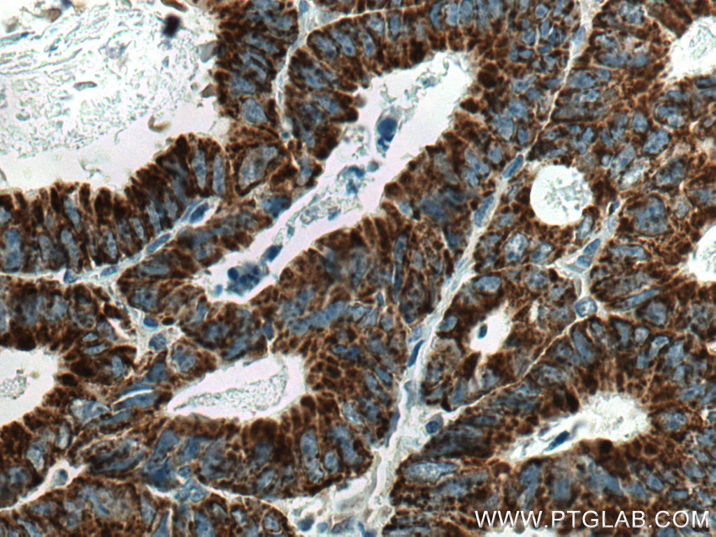 IHC staining of human colon cancer using 67798-1-Ig (same clone as 67798-1-PBS)